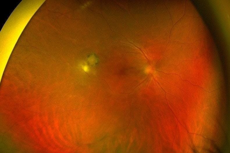 Toxoplasmosis: what is new in 2023?