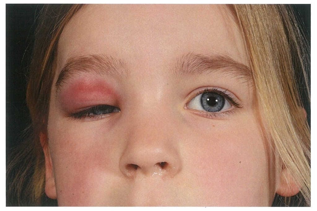 CASE STUDY: periorbital cellulitis or worse?