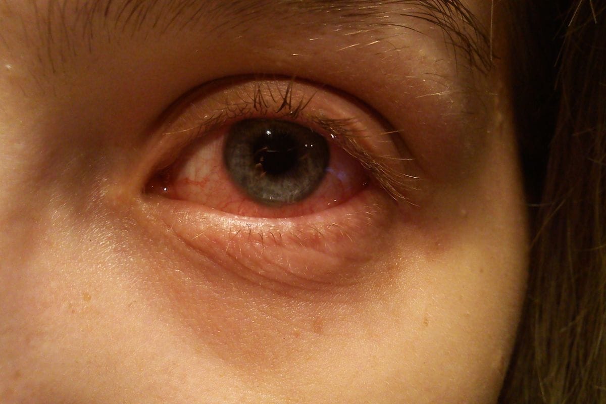 Covid-19: Eyes a source of contagion?