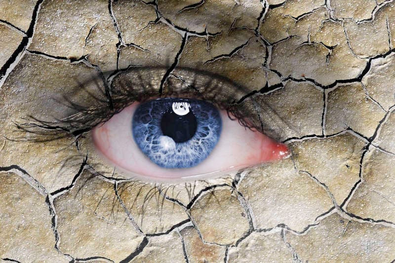 Dry eye in practice