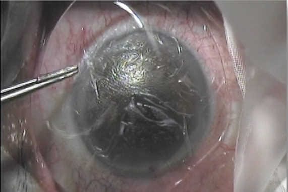 Research update: amniotic membrane for DED
