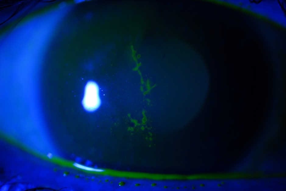 Update on herpes zoster ophthalmicus
