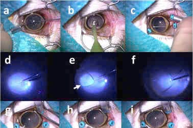 Macula implant eye changes