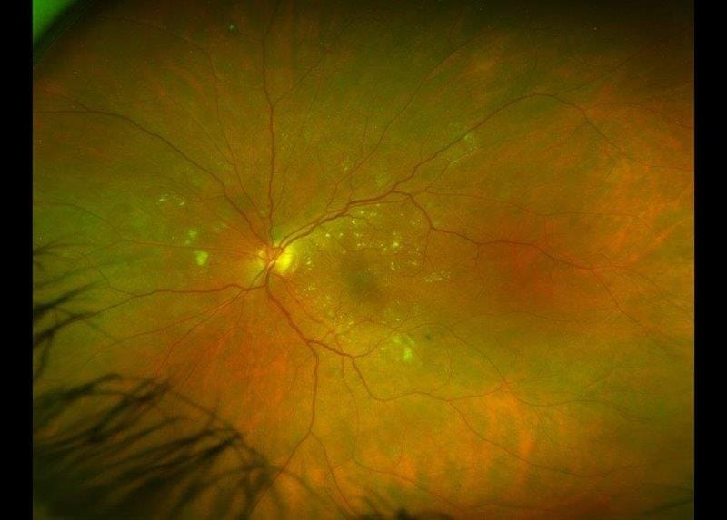DMO: looking beyond HbA1c