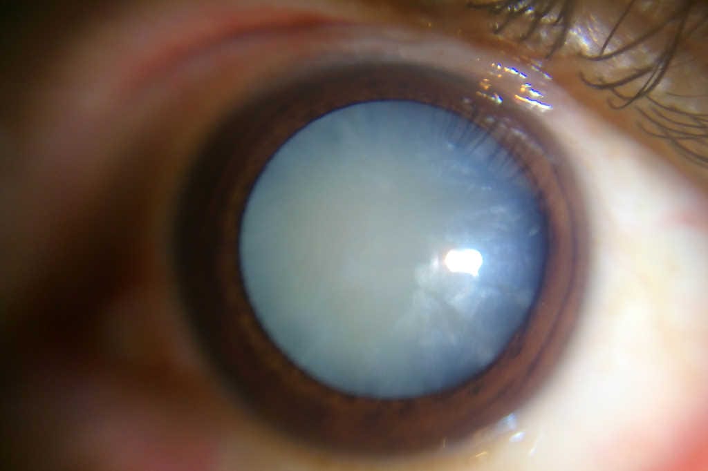 Cataracts: patient education needed