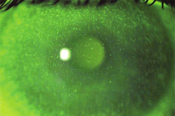 Residual refractive error after cataract surgery