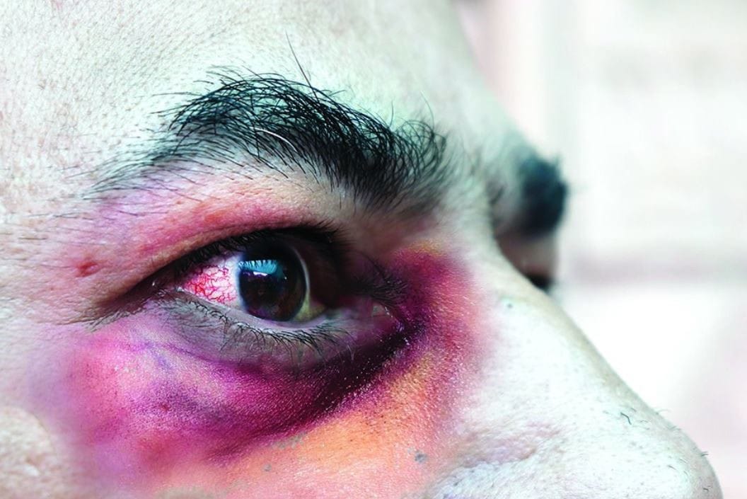 Covid spikes mucormycosis cases