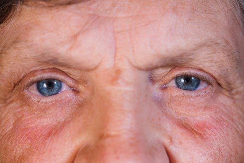 Improving SS screening accuracy among DED patients