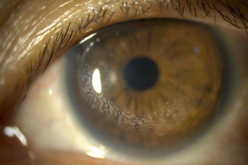 corneal epithelial ingrowth