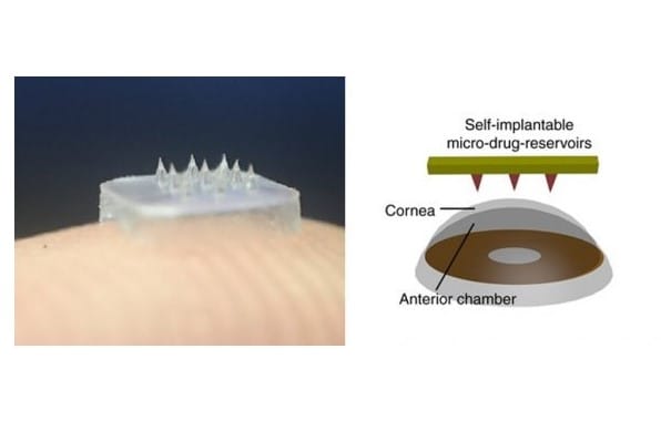 Corneal patch injects drugs