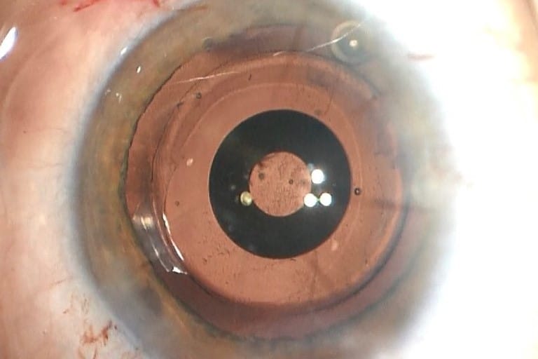 CASE STUDY: A new option for restoring vision with irregular corneas