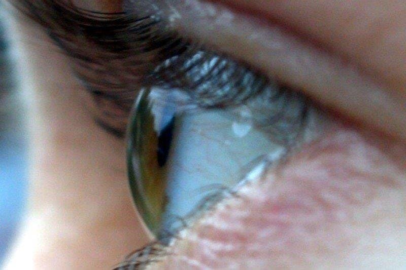 Approaches to revitalising or replacing the corneal endothelium