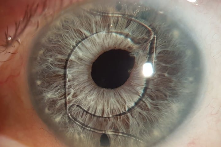 The evolution of cataract surgery since Ridley’s first IOL