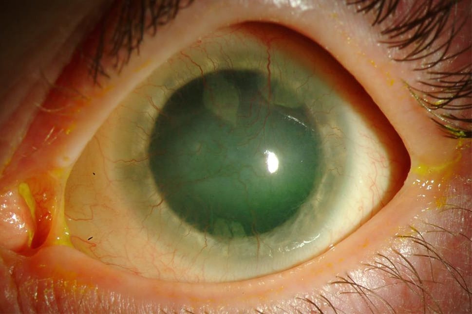 Stevens-Johnson syndrome and the ocular surface