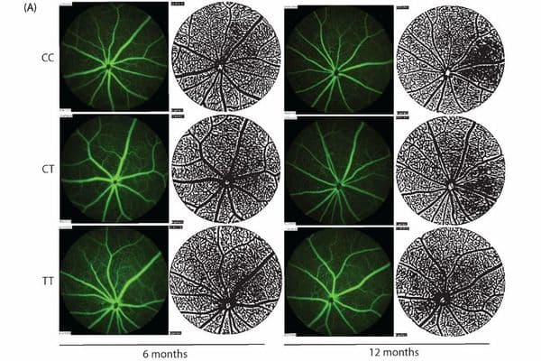 Retinal imaging biomarker for Alzheimers