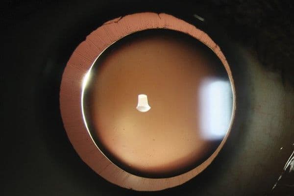 Spherophakia image wins slit lamp competition