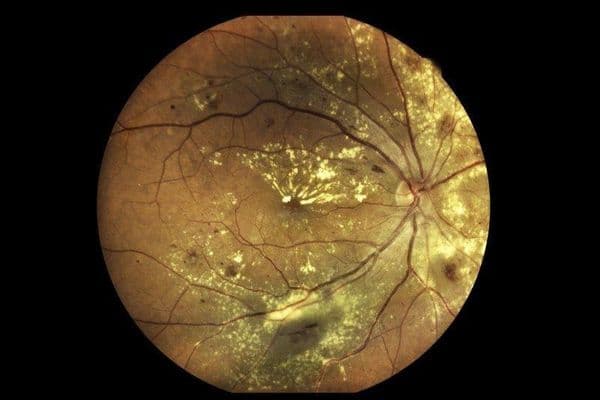 Parkinson’s drug delays nAMD progression