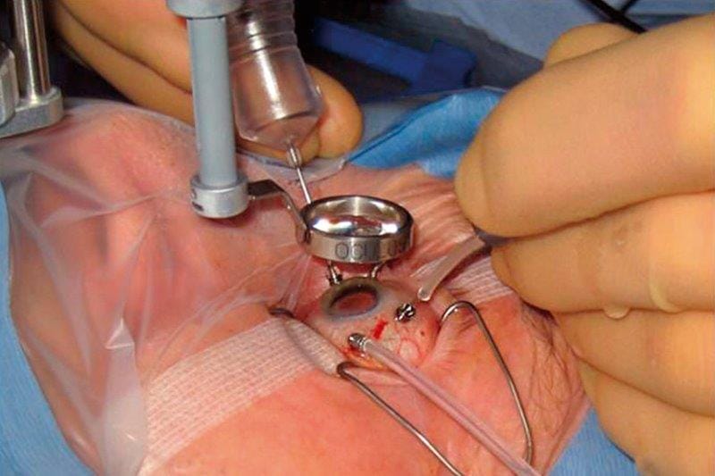 pars plana vitrectomy small