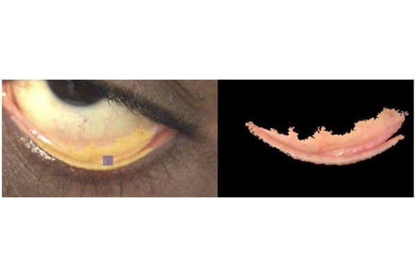 Smartphone photos to detect anaemia?
