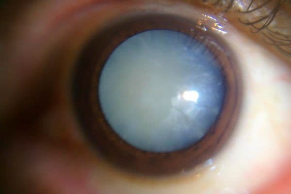 Post-op cataract checks could go