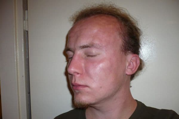 angioedema