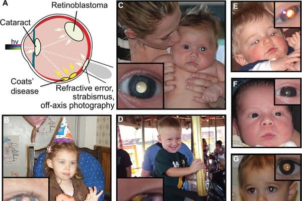 App detects eye disease from photos