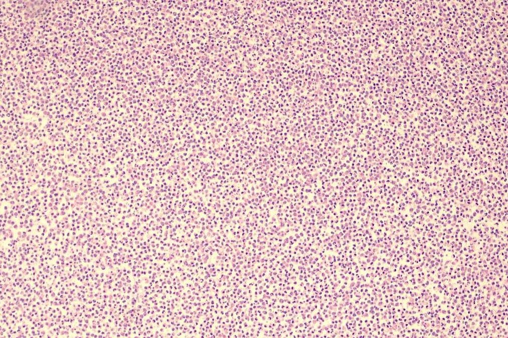 endophthalmitis case