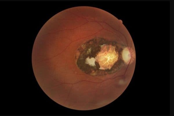 Macular lesion