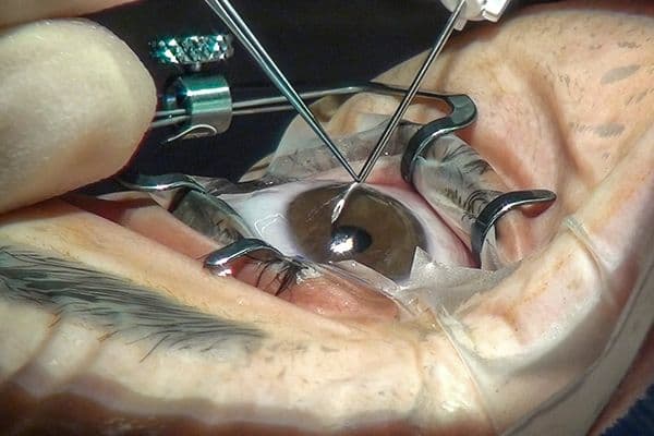 MIGS safe in POAG myopes