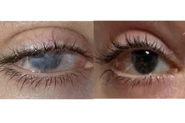 Topical gene therapy restores sight