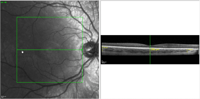 Fig 2 Case One, Choroidal Thickness At One Month Follow Exam