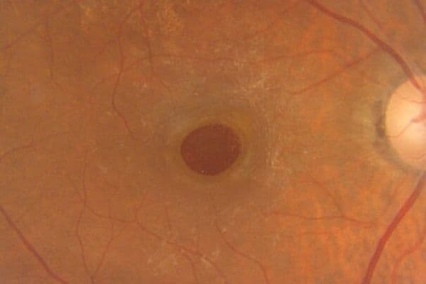 macular hole