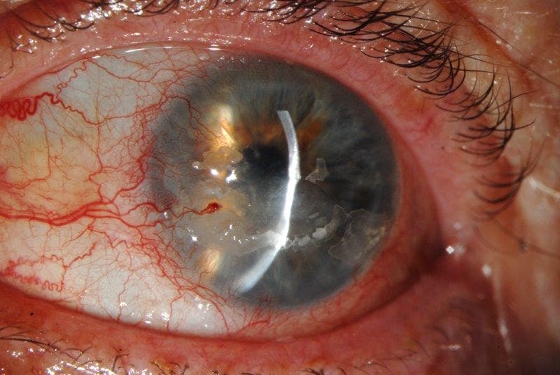 Update on herpes zoster ophthalmicus-fig-2.jpg