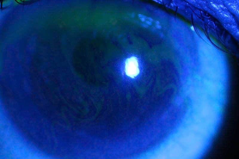 Cataract surgery and dry eye