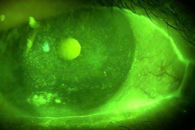 TFOS survey of DED diagnosis patterns