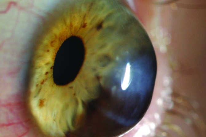 Keratoconus link with immune system found