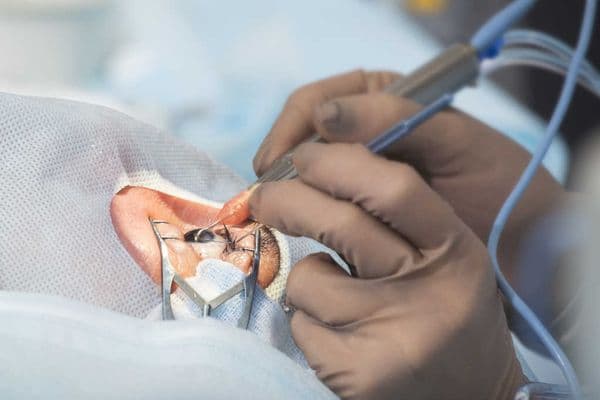 Improving the provision of cataract surgery in New Zealand demands disruptive change