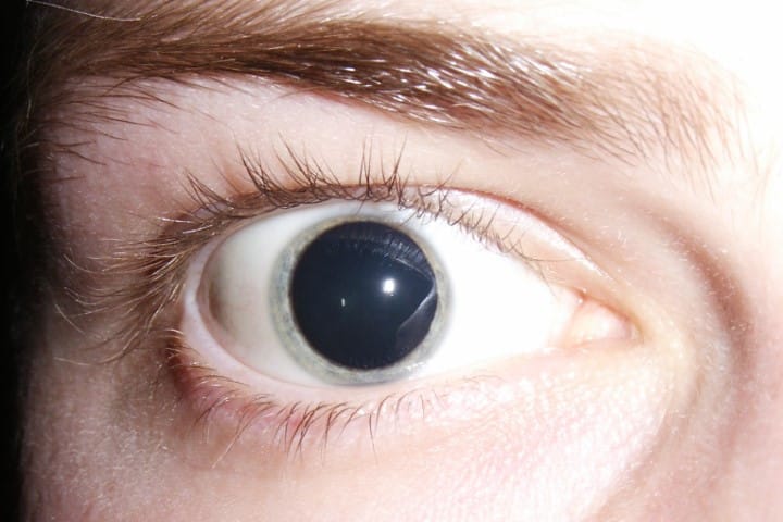 Anti-mydriasis drops approved
