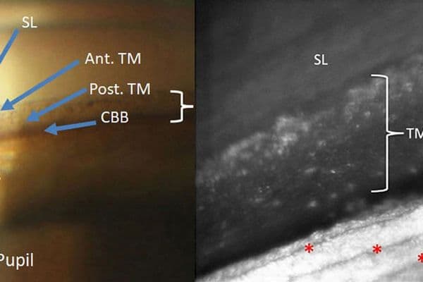 Glaucoma up close