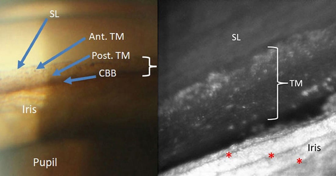 Glaucoma up close