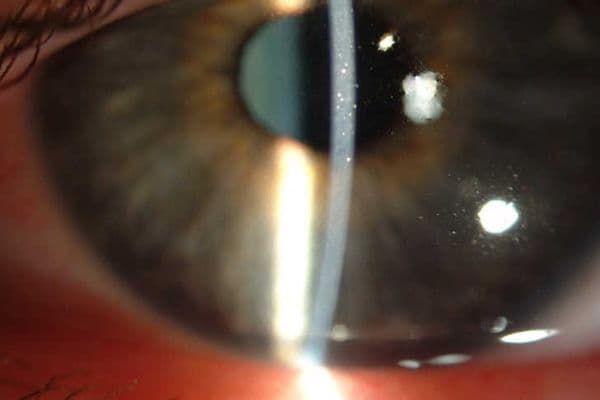 Gel drops reduce corneal scarring