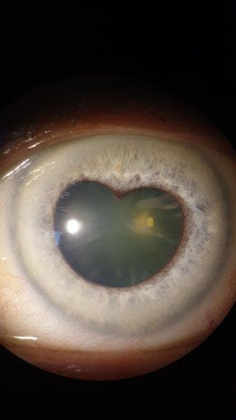 CCLS Photo Comp Second Eye Love U Veitis (1)