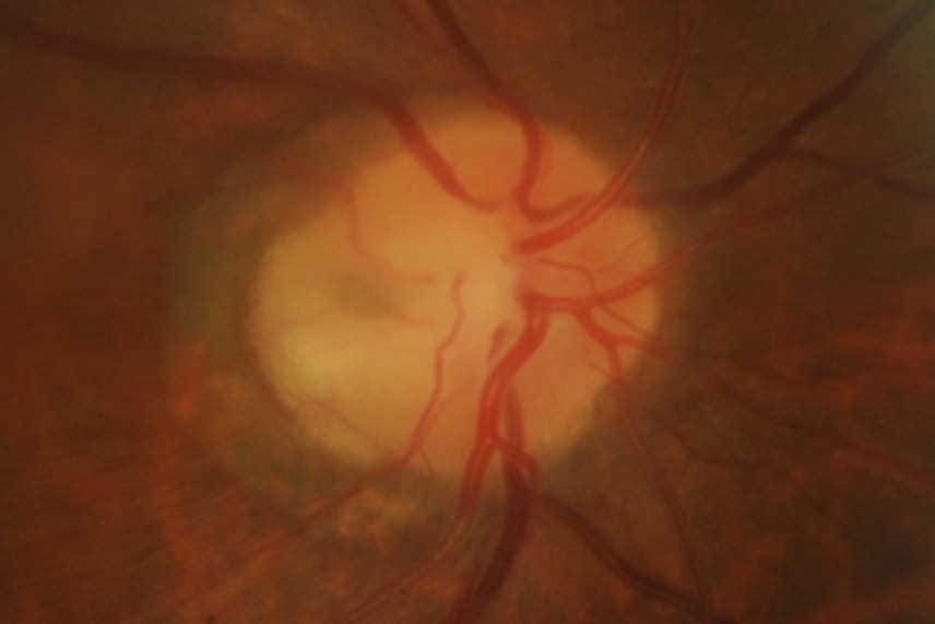Optic disc pit with maculopathy