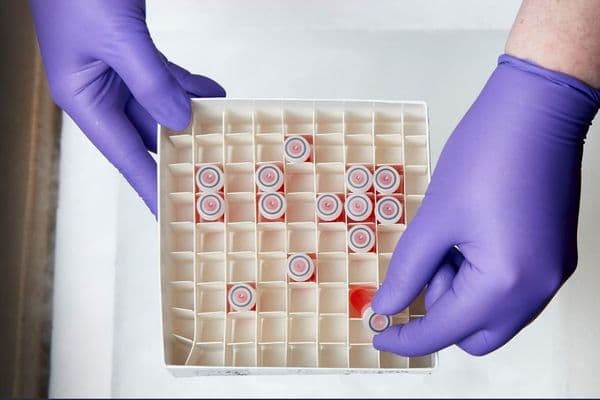 Kidney disease retinopathy marker for CVD