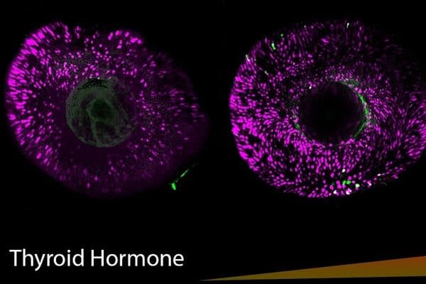 Thyroid hormone alters colour vision