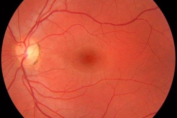 fundus photograph of normal left eye