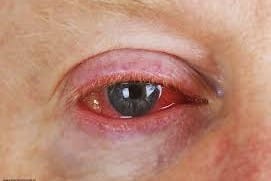 Povidone-iodine shows promise for viral conjunctivitis