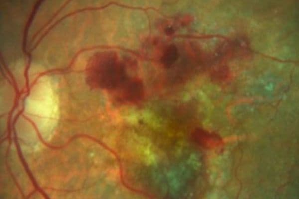 Six-monthly wet AMD IVT