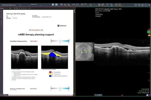 AI boosts nAMD therapy planning