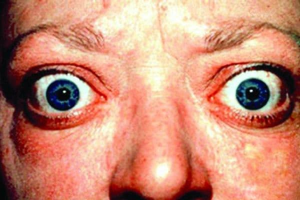 Smartphone exophthalmos evaluation success